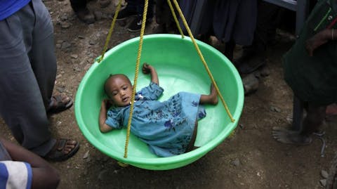 ondervoeding oost afrika